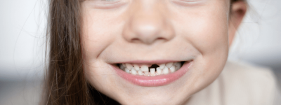 dientes de leche: cuándo se caen y cómo cuidarlos